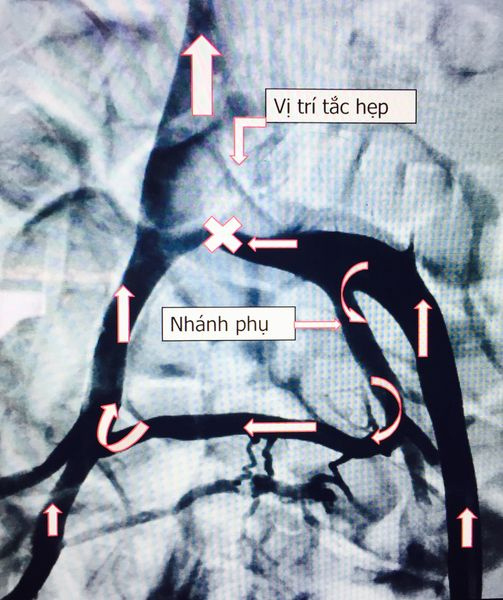 chụp tĩnh mạch