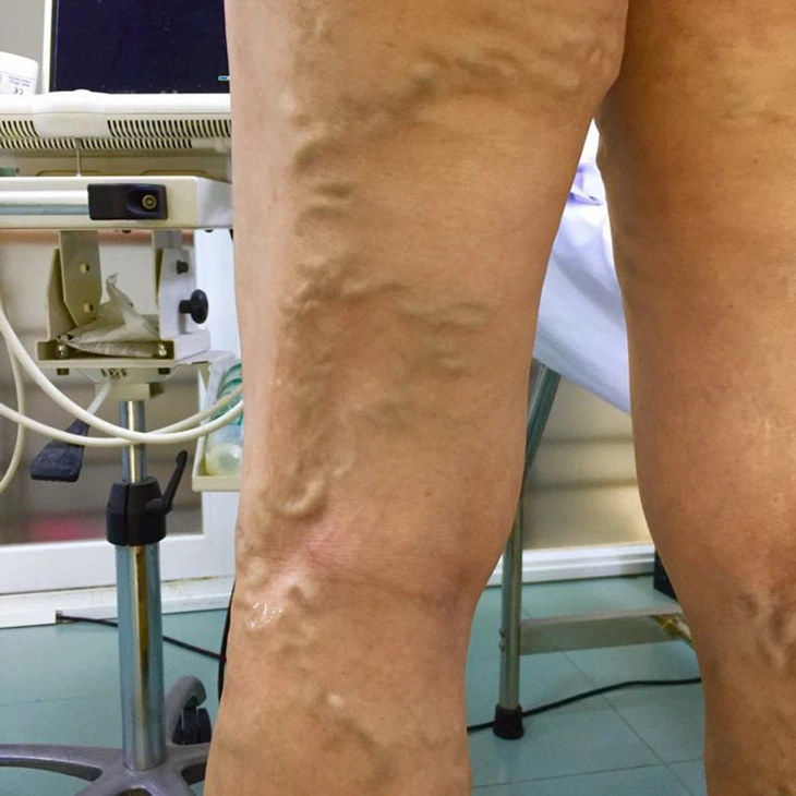 Giãn tĩnh mạch vùng chậu – bệnh khiến phụ nữ đau khi quan hệ tình dục